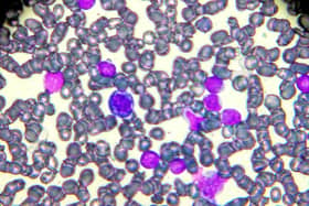 New treatment for children and adults with leukaemia (photo: Getty Images/iStockphoto)