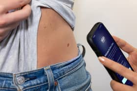 Skin Analytics’ DERM Zero is the first to recurve clearance to autonomously check skin lesions via a smartphone