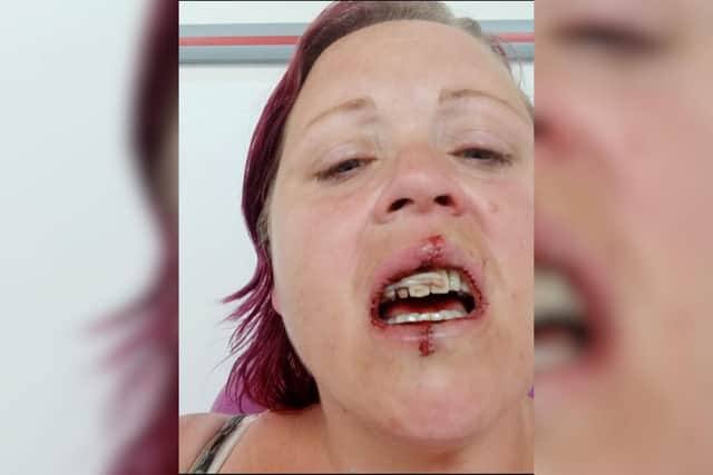 Kate Scott shows stiches to her lip after her ex-partner threw a glass ashtray at her face