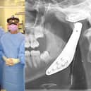 Left: The team who carried out the first total jaw replacement with an x-ray of the jaw after surgery. Picture: Bedfordshire Hospitals NHS Foundation Trust