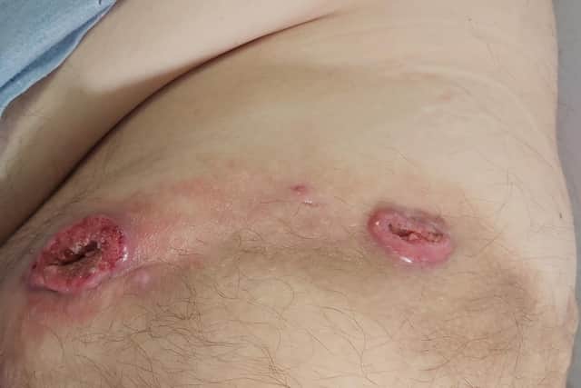 Some of the sores which appeared on Don's body. Picture: Don Logan