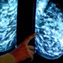 The number of women opting for a routine breast screening mammogram is below that of the pandemic