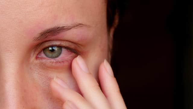 Sore, itchy eyes may be a warning sign of a Covid-19 infection (Photo: Shutterstock)