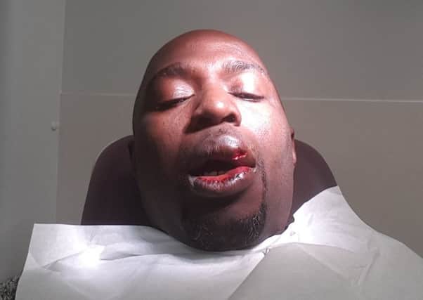 Henry Ifesi after the attack