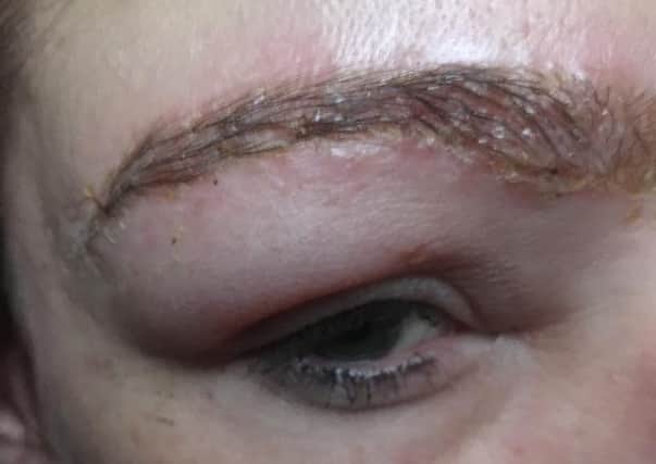 Reaction to eyebrow tint and shape treatment