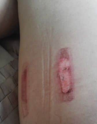Wounds on one of Marcela's legs, pictured a week after the 'fat freezing'