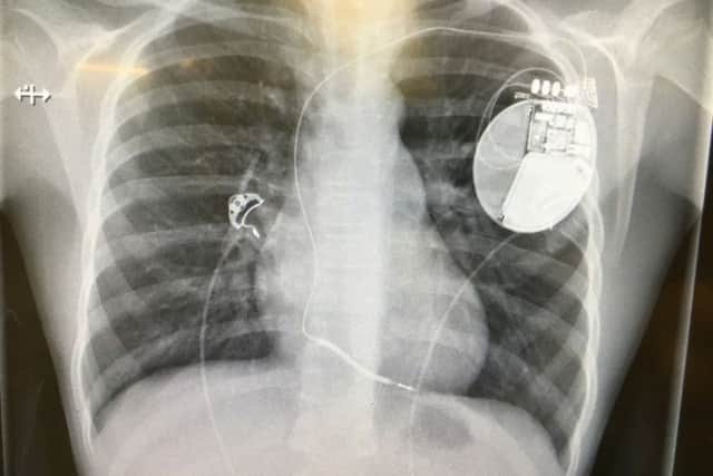 The 11-year-old has been given an implantable cardioverter defirillator