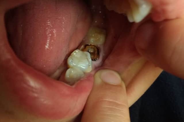 The infected tooth